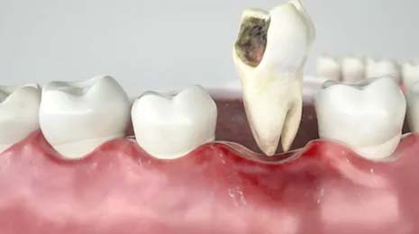 dental extraction clinic in mansarovar