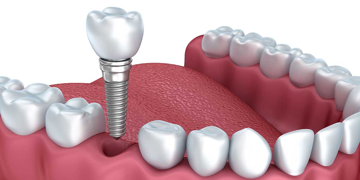 dental implant clinic in Mansarovar, Jaipur