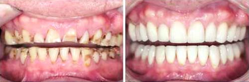 full mouth rehabilitation dental clinic in mansarovar Jaipur